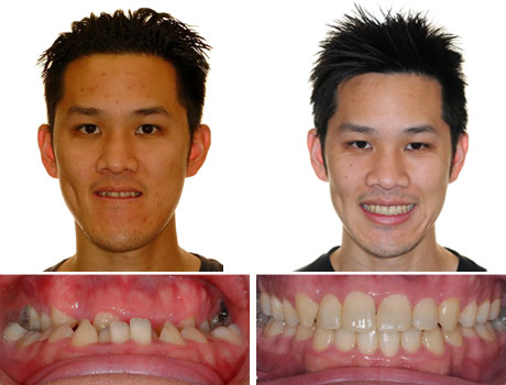 Before and After - San Diego Invisalign, Braces, Orthodontist